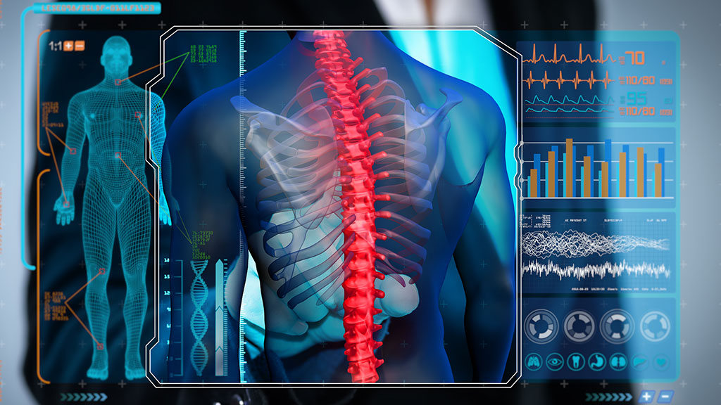 A New Expandable Spine Implant